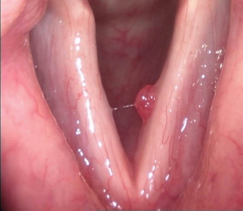Accuracy of Diagnosis of Benign Vocal Fold Lesions among Ear, Nose, and Throat Residents.