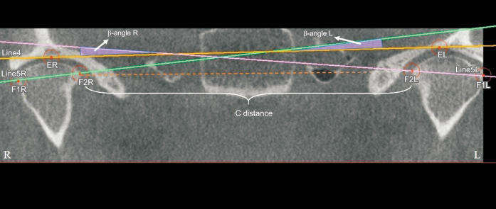 Evaluation of mandibular condyle position in Class III patients after bimaxillary orthognathic surgery: A cone-beam computed tomography study.