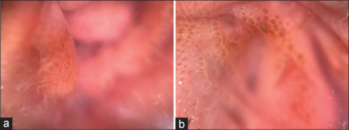 Micropapillomatosis labialis - Report of three cases.