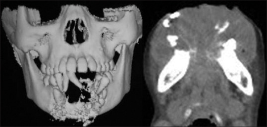 Aggressive Osteosarcoma of the Mandible in a 13-Year-Old Girl.