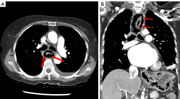 Conservative management of emphysematous esophagitis-a case report.