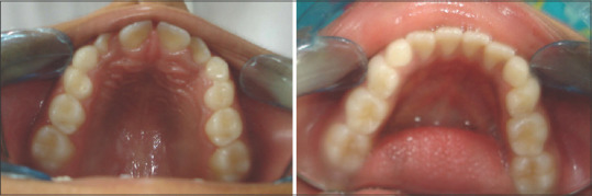 Assessment of Factors Associated with Mandibular Anterior Crowding in Mixed Dentition.