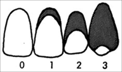Comparative evaluation of oral hygiene status by using oral hygiene index, simplified oral hygiene index, and modified oral hygiene index: Revalidation of modified oral hygiene index.