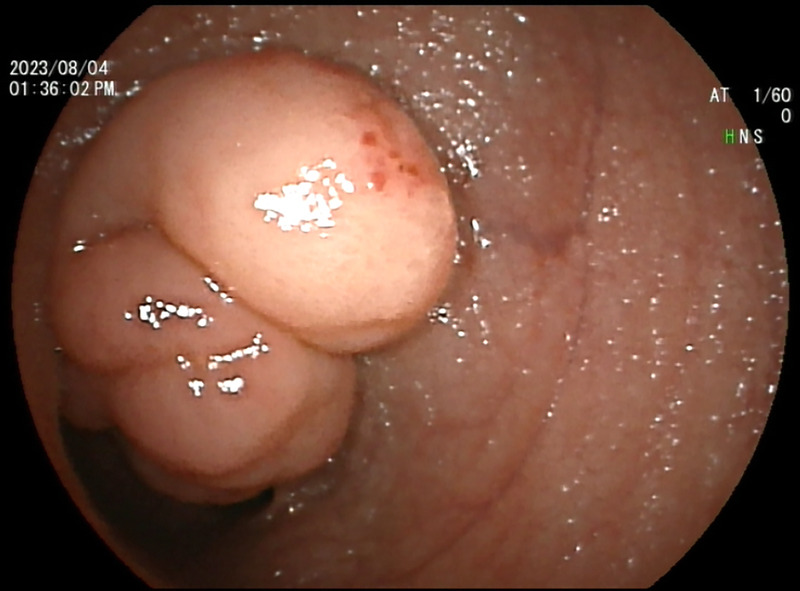 A rare but interesting case of small intestinal tumor diagnosed by transrectal EUS-FNA (with video).