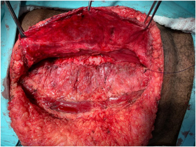 INTRA-ABDOMINAL PRESSURE MONITORING DURING LÁZARO DA SILVA'S PROCEDURE FOR VENTRAL HERNIA REPAIR: A CROSS-SECTIONAL STUDY.