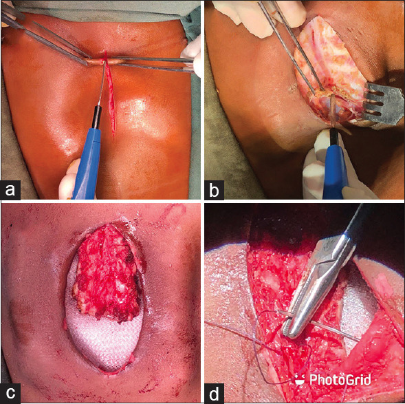 Single-stage Open Lobectomy and Modified Ravitch Procedure in an Infant with Coexisting Severe Pectus Excavatum and Congenital Cystic Adenomatous Malformation.