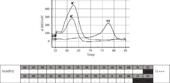 Loss of Recurrent Laryngeal Papillomatosis following Postsurgical Treatment with dsRNA Interferon Inducer.