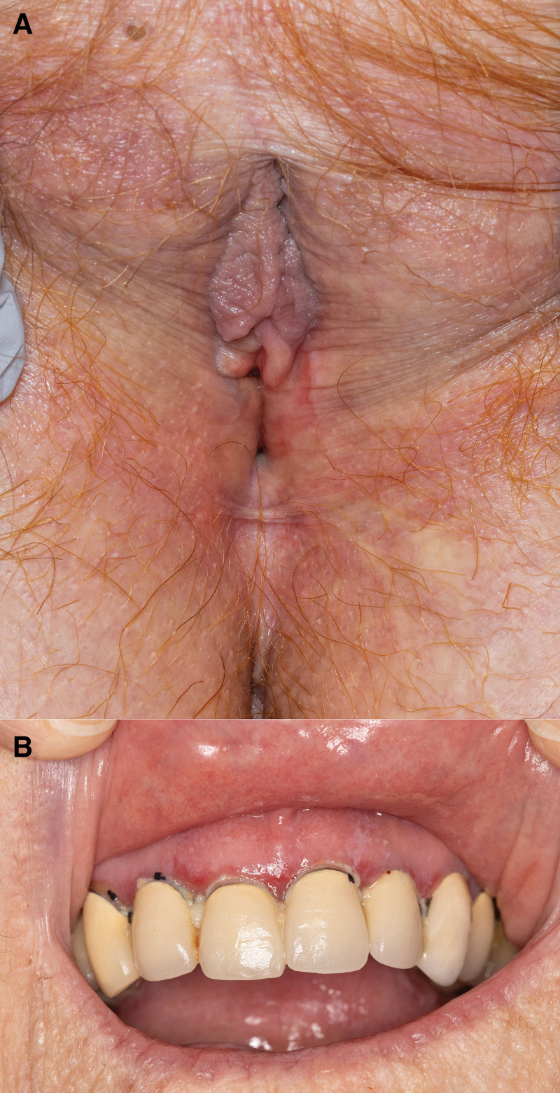 Lichenoid tissue eruption of the vulva associated with immune checkpoint inhibitor.