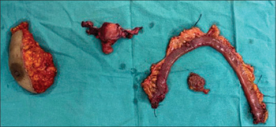 Clinicopathological Characteristics of Multiple Primary Malignancies Involving Female Genital Tract at a Tertiary Cancer Institute of Northeast India.