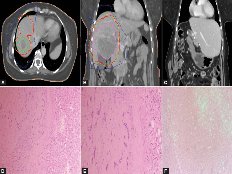 Perihilar and Intrahepatic Cholangiocarcinoma after Resection: Clinicopathological Characteristics, Outcomes, and Implications for Addition of Chemoradiotherapy.