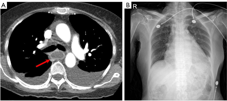 Conservative management of emphysematous esophagitis-a case report.