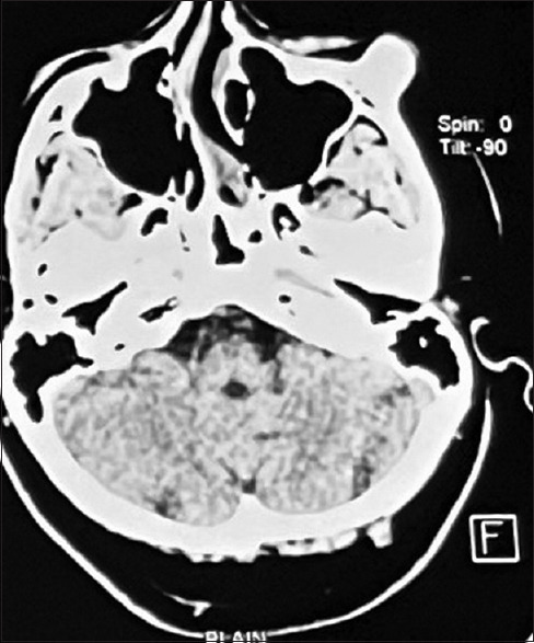 Osteochondroma below the Infraorbital Rim - A Case Report.