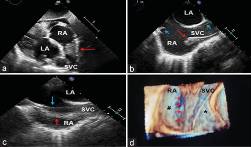 Prominent Crista Terminalis Mimicking Right Atrial Thrombus in a Case of Permanent Pacemaker Implantation - Role of Two- and Three-Dimensional Transesophageal Echocardiography.