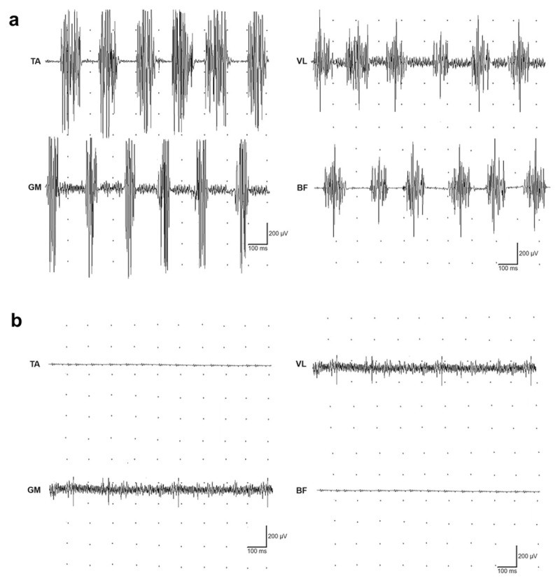Pseudo-Orthostatic Tremor in Graves' Disease: A Possible Early Sign of Parkinsonism?