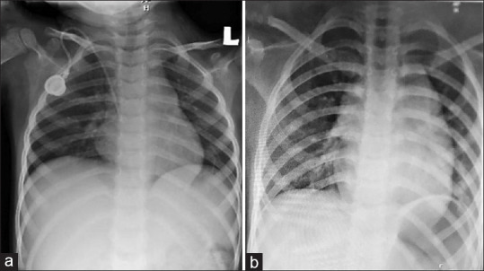 Difficult Removal of a Stuck Chemoport Catheter of a Paediatric Patient in Post-Coronavirus Disease (COVID-19) Era - Management Strategies and Literature Review.