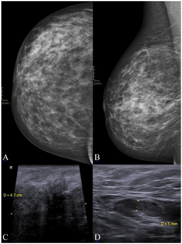 Idiopathic Granulomatous Mastitis, Erythema Nodosum, and Polyarthritis.
