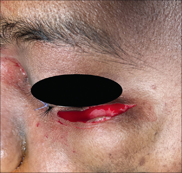 Osteochondroma below the Infraorbital Rim - A Case Report.
