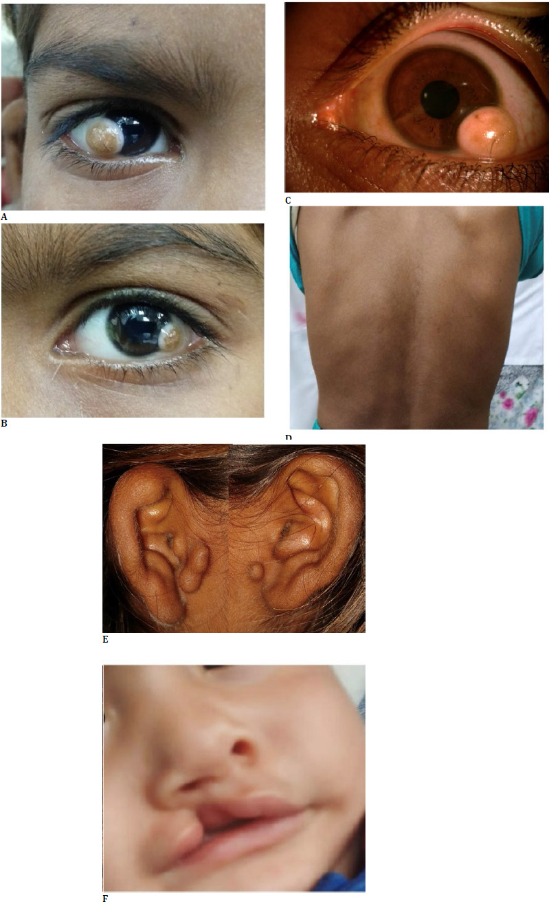 Managing Limbal Dermoids in Patients with Goldenhar Syndrome: A Case Series.