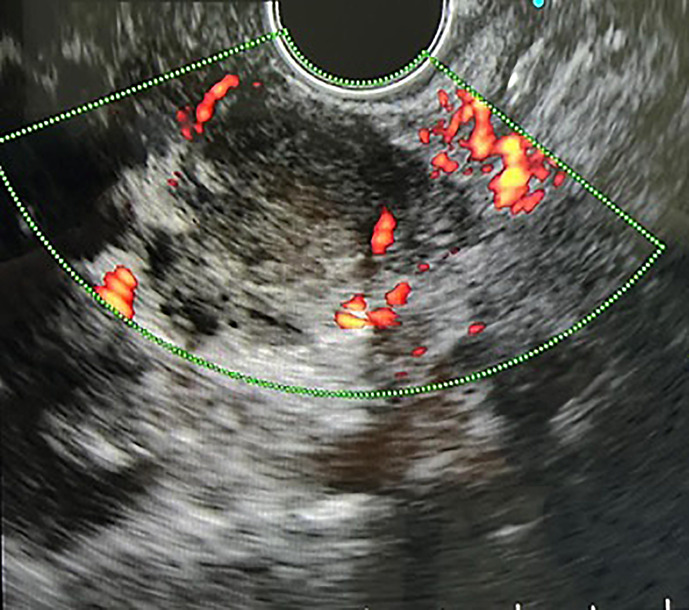 Tuberculosis of the Stomach Mimicking Gastric Submucosal Tumor: Diagnosis by Endoscopic Ultrasound.