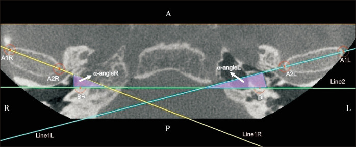 Evaluation of mandibular condyle position in Class III patients after bimaxillary orthognathic surgery: A cone-beam computed tomography study.