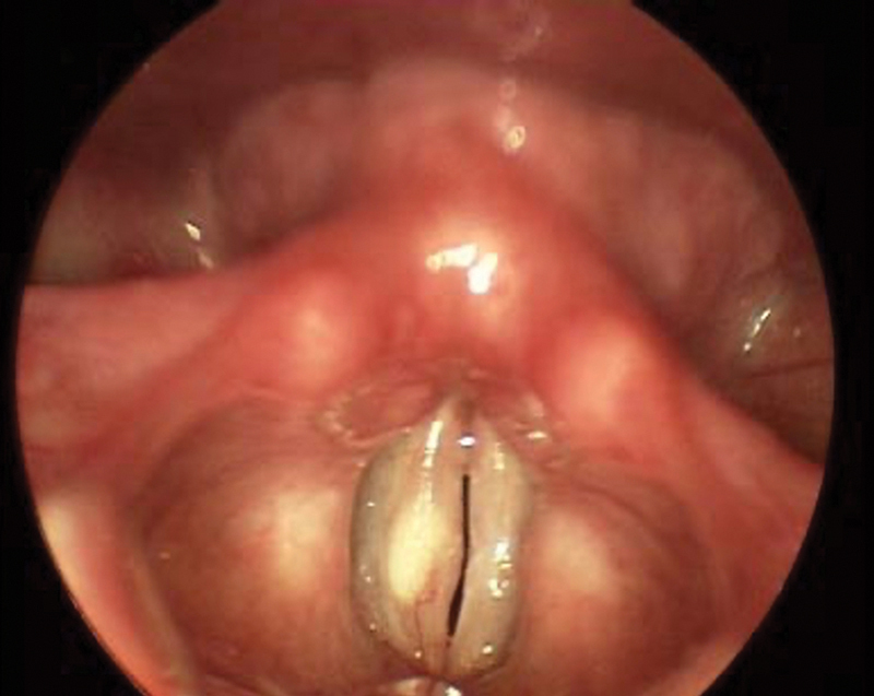 Accuracy of Diagnosis of Benign Vocal Fold Lesions among Ear, Nose, and Throat Residents.