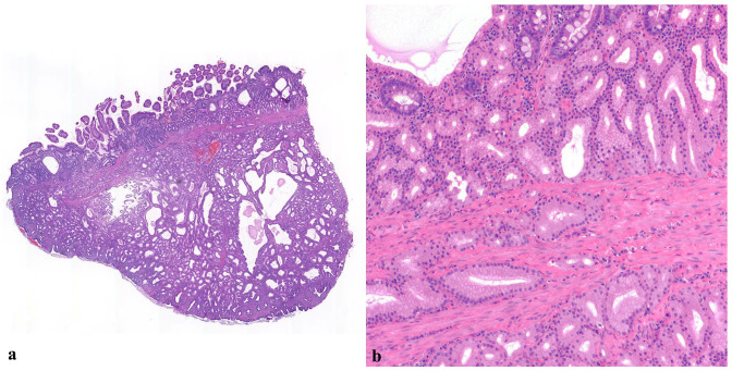 Brunner's gland adenomas in two cats.