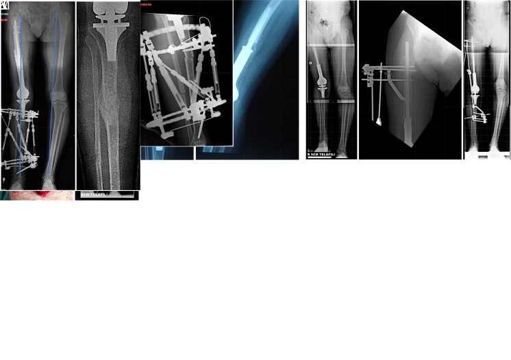 Advancing pediatric bone sarcoma care: navigating complications and innovating solutions in limb salvage and reconstruction-why, when, and how to treat limb length inequalities.