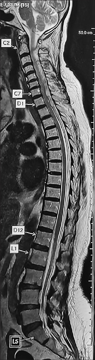 Catastrophic spontaneous spinal epidural hematoma following thrombolysis: An intersection of neurosurgical and cardiological challenges - An institutional experience.