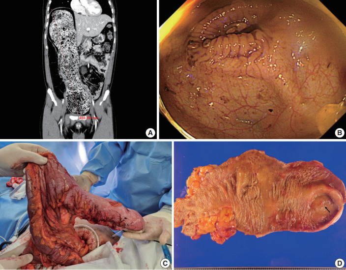 Tubular adenoma arising in tubular colonic duplication: a case report.