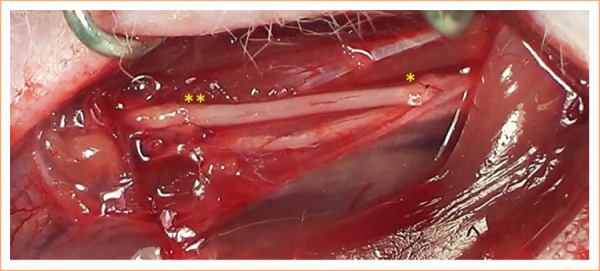 End-to-side neurorrhaphy in the reconstruction of peripheral segmental neural loss: an experimental study.