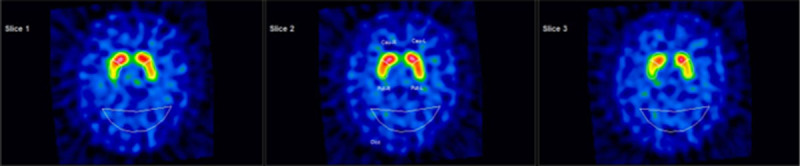 Pseudo-Orthostatic Tremor in Graves' Disease: A Possible Early Sign of Parkinsonism?
