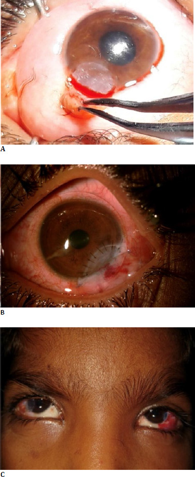 Managing Limbal Dermoids in Patients with Goldenhar Syndrome: A Case Series.