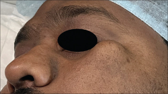 Osteochondroma below the Infraorbital Rim - A Case Report.