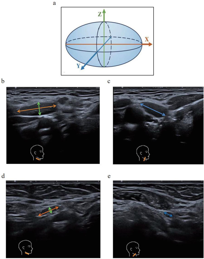 Deep cervical lymph nodes in Parkinson's disease and atypical Parkinson's disease: A potential ultrasound biomarker for differential diagnosis.