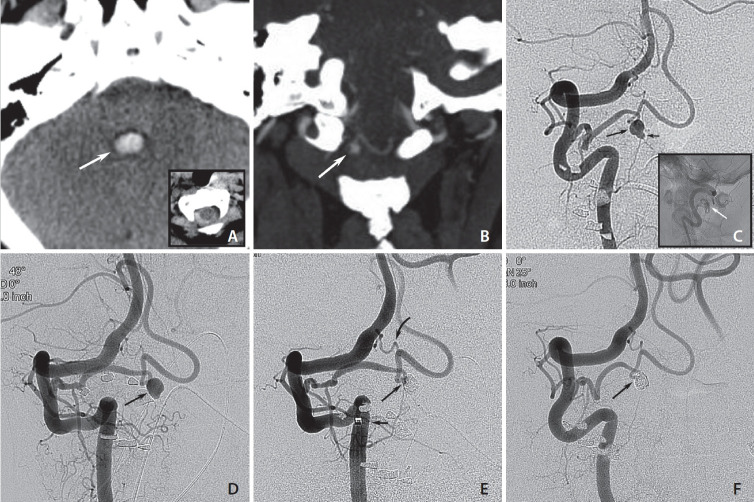 Endovascular Management of a Ruptured Aneurysm on a Posterior Inferior Cerebellar Artery with Extradural C2-Origin: Case Report and Literature Review.