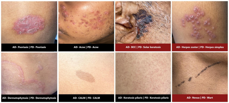 Efficacy of an Artificial Intelligence App (Aysa) in Dermatological Diagnosis: Cross-Sectional Analysis.