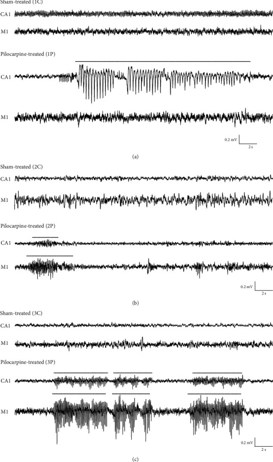 A Novel Rat Infant Model of Medial Temporal Lobe Epilepsy Reveals New Insight into the Molecular Biology and Epileptogenesis in the Developing Brain.