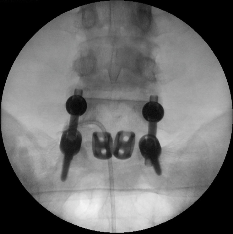 Failed back surgery syndrome-terminology, etiology, prevention, evaluation, and management: a narrative review.
