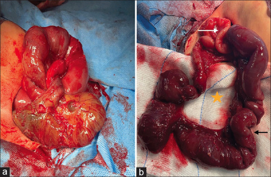 Congenital Mesenteric Defect with Transmesenteric Hernia in Children: A Case Series.