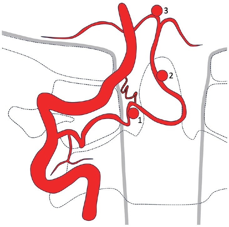 Endovascular Management of a Ruptured Aneurysm on a Posterior Inferior Cerebellar Artery with Extradural C2-Origin: Case Report and Literature Review.