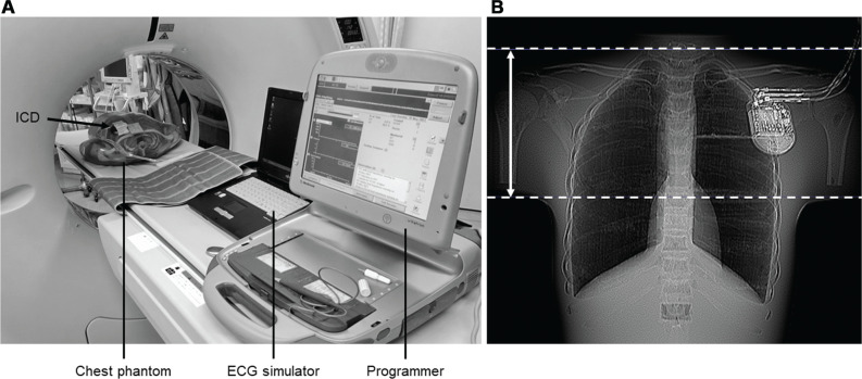 Effects of Irradiation During Computed Tomography Scanning on the Function of Implantable Cardioverter-defibrillators.