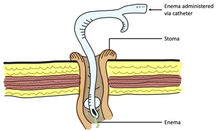 A Foley catheter 'the jack of all trades': a literature review of its common and novel uses.