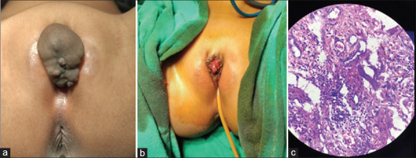 Isolated Vascular Malformation of the Clitoris: An Uncommon Cause of Clitoromegaly.