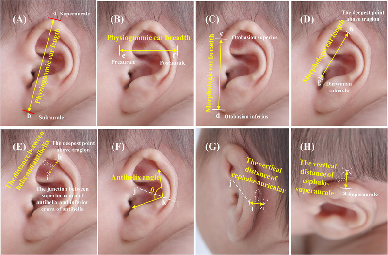 Investigation of morphometric features of auricle in newborns and etiology of auricle deformity.