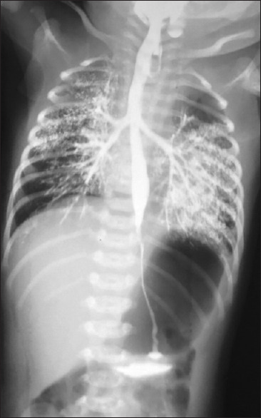 Inadvertently Displayed Trajectory of Type C Oesophageal Atresia during a Contrast Study.