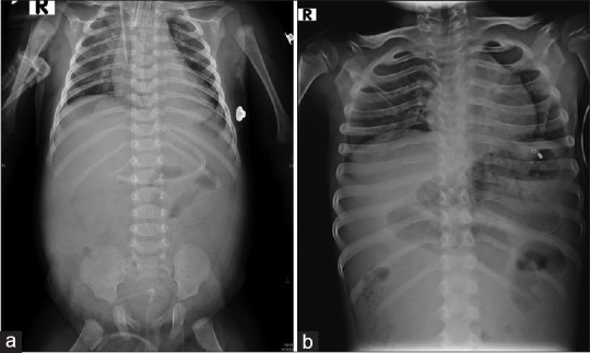 Congenital Mesenteric Defect with Transmesenteric Hernia in Children: A Case Series.