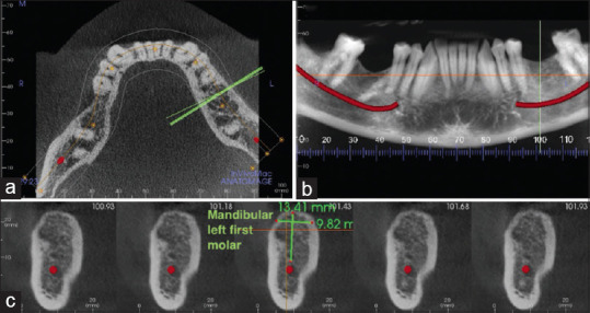 Accuracy of Implant Size Prediction Based on Edentulous Ridge Dimension on Cone-beam Computed Tomography - A Retrospective Study.