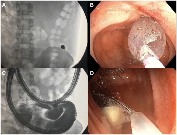 Interventional endoscopy in inflammatory bowel disease: a comprehensive review.