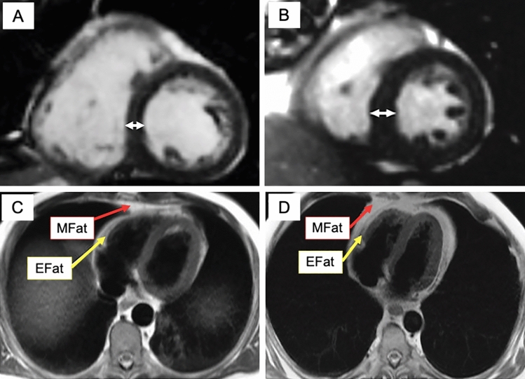 Central Obesity is Associated with Increased Left Ventricular Maximal Wall Thickness and Intrathoracic Adipose Tissue Measured with Cardiac Magnetic Resonance.