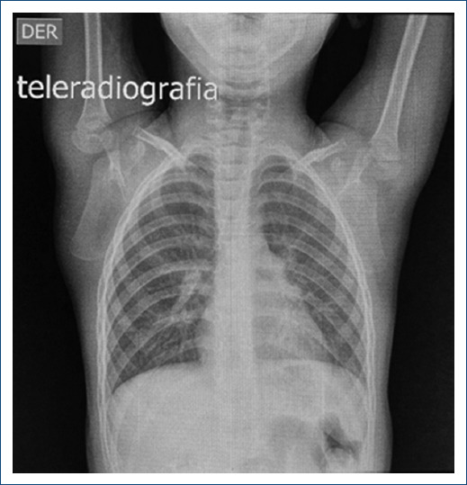 Management of supravalvular aortic stenosis with the Doty technique, in a South American pediatric center.